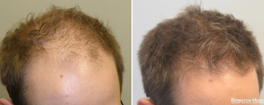 tratamento contra queda de cabelo
