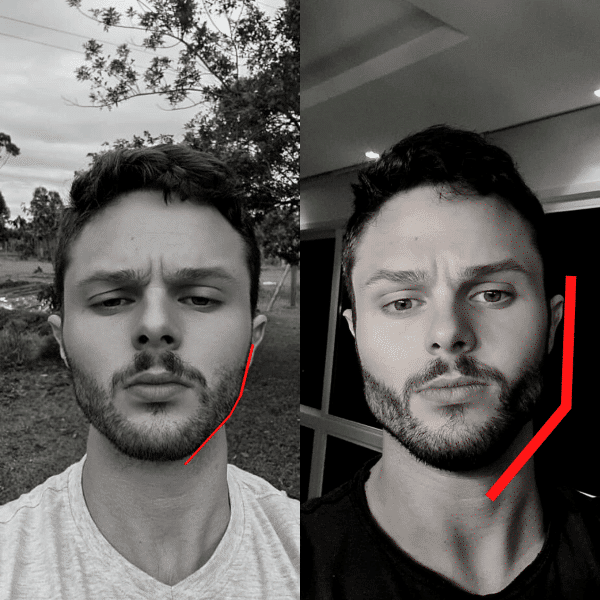 antes e depois Golden Jaw 