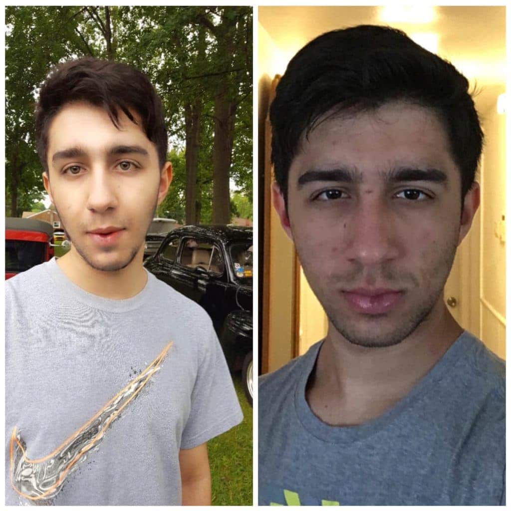 antes e depois mewing 
