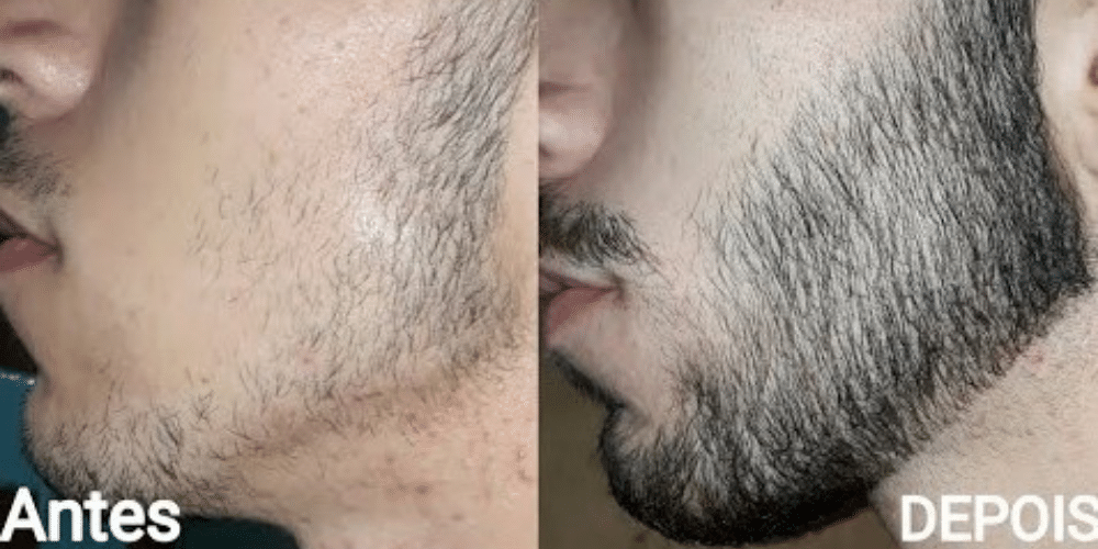 Minoxidil para barba