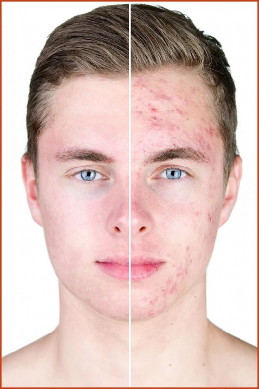 Close no rosto de um rapaz branco que mostra o antes e depois do tratamento contra manchas na pele provocados por acne.