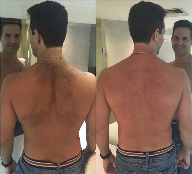 Close nas costas de um homem branco  mostrando o antes e o depois de uma depilação a laser masculina