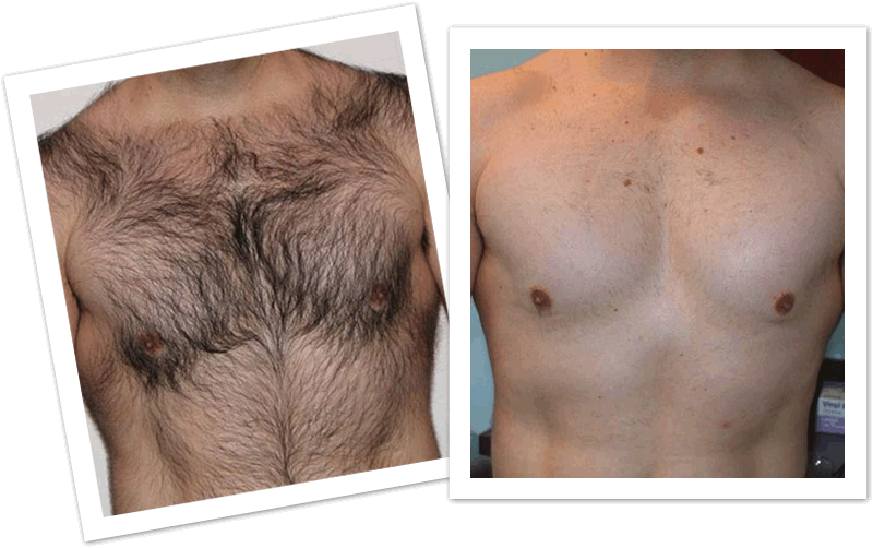 Close no peito de um homem branco mostrando o antese o depois de uma depilação a laser masculina