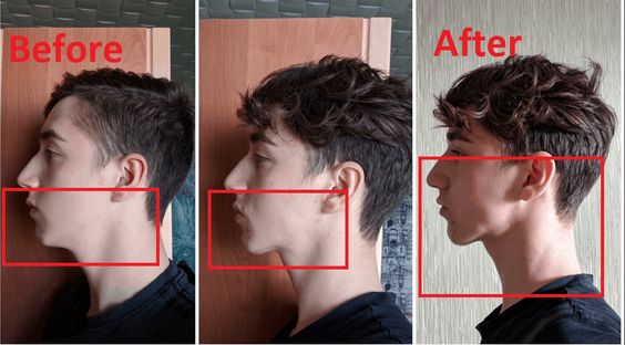 Close em perfil de rapaz branco num Antes e Depois de ginástica facial