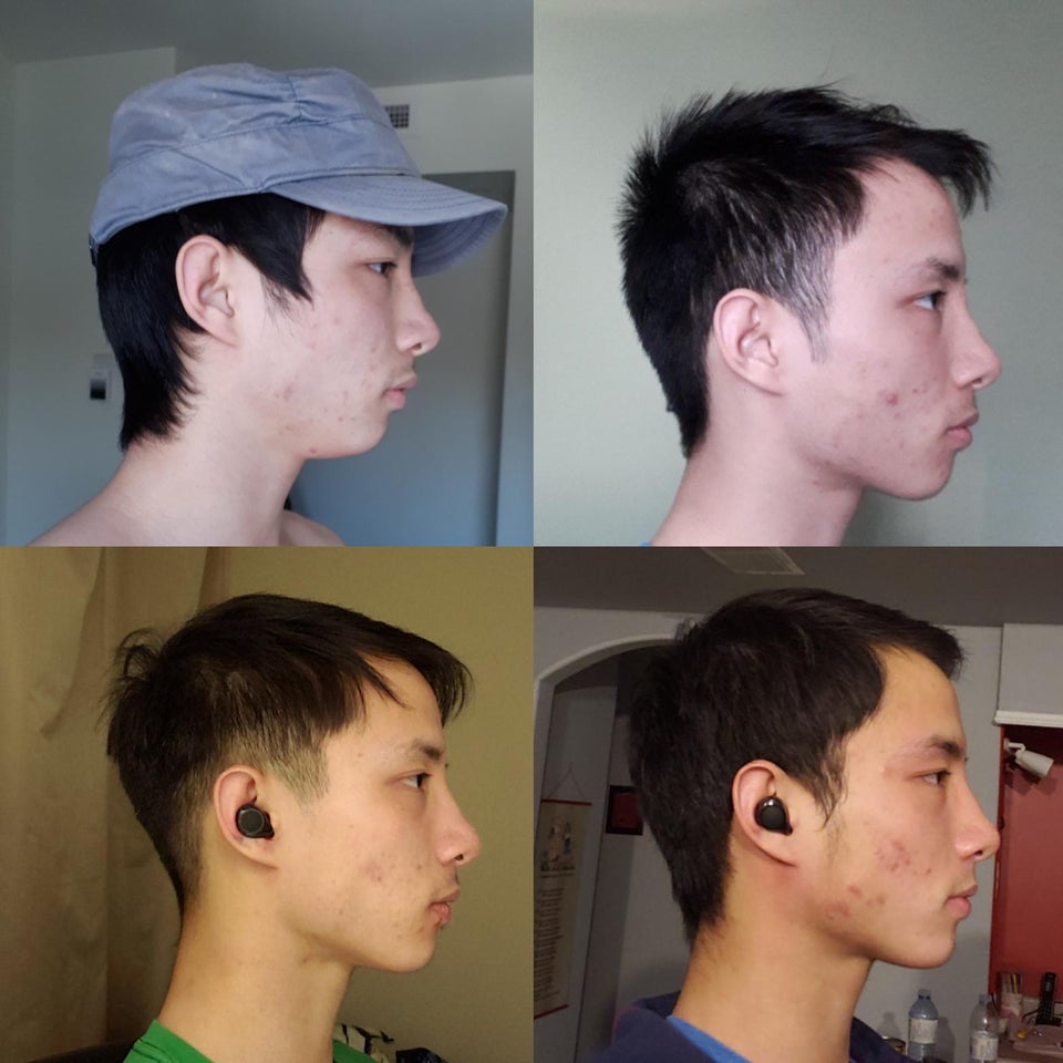 Close em perfil de rapaz asiático num Antes e Depois de ginástica facial