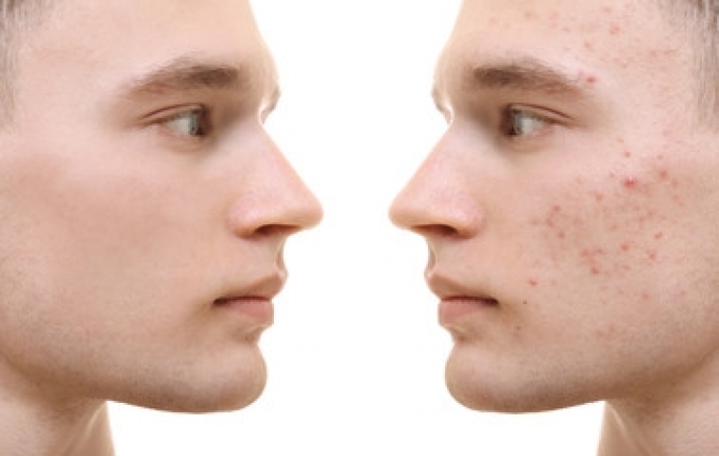 Close em rosto de jovem  com um antes e depois de tratar suas manchas de pele