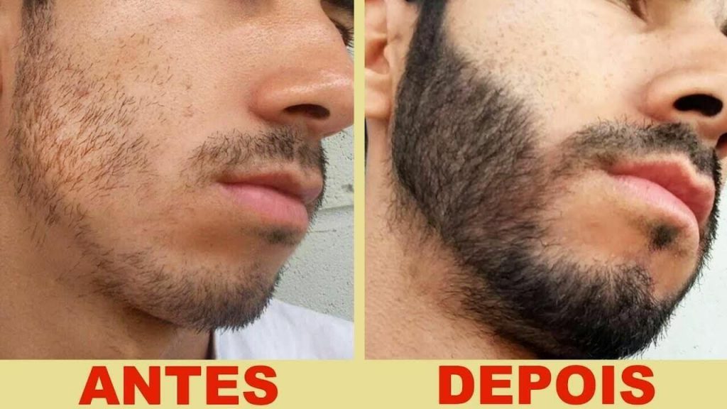 Close no rosto de um homem branco mostrando o antes e o depois da aplicação de minoxidil